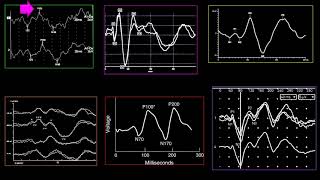 Visual evoked potentials Part 2 [upl. by Zobias]