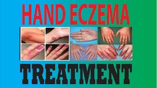 DyshidrosisDyshidrotic eczemaHand eczemaPompholyx treatment [upl. by Elocyn]