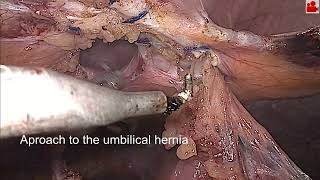 LIRA An alternative in Minimally Invasive Hernia Surgery [upl. by Esilehs]