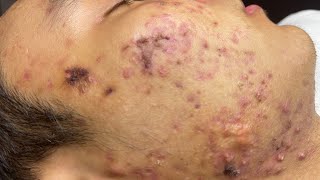 ACNE TREATMENT VU QUYNH MI Blackheads On Boy Face 2024 [upl. by Fontana]