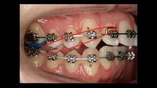 Uso de los elásticos en Ortodoncia Fija [upl. by Iaria]