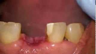 Suture removal after a dental implant placement [upl. by Nalani854]