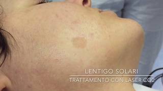 Lentigo solari  Trattamento con Laser CO2 [upl. by So]