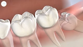 Wisdom Teeth Removal in Modesto CA  Greater Modesto Dental Implant amp Oral Surgery Center [upl. by Esbenshade749]