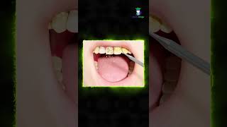 315 Healthy gums What is a plaque  பல் படலம் என்றால் என்ன  DrKarthikeyan  Denta Kings [upl. by Ntsyrk503]