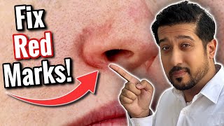 Redness Around Nose  Get Rid of Perioral Dermatitis FAST [upl. by Sissy]