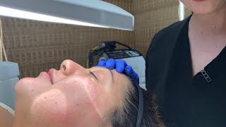 Extractions  Facial Treatment  West Hollywood CA  Dr Jason Emer [upl. by Fan]