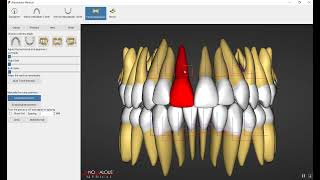 Orthognathic Surgery Part 5 المرحلة الخامسة [upl. by Land]