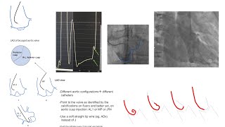 Left ventricular catheterization including AS and left ventriculography Diagrams and cases [upl. by Drofla]