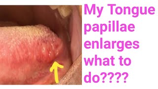 Enlarged tongue papillaeFoliate papillae enlarges whyI have enlarged tongue Papillae what to do [upl. by Chicoine]