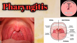 Pharyngitis  causes  management  symptoms [upl. by Nosreve]