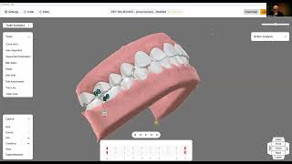ArchForm un software muy completo para movimientos de ortodoncia [upl. by Aldon]