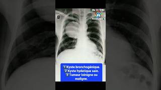 chest xray radiographie thoracique doctor covid hospital [upl. by Finny859]