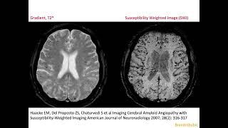 68 CAA Cerebral Amyloid micro Angiopathy vascular dementia micro bleeds superficial siderosis [upl. by Eissalc371]