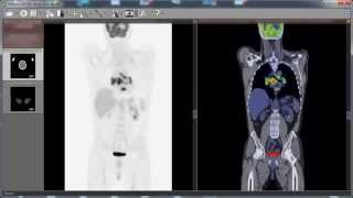 RadiAnt DICOM Viewer PETCT fusion preview [upl. by Joktan]