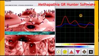 Atheromatous Aorta Medicomat Aorta Treatment [upl. by Hofmann]