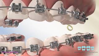 Posterior Crossbite Elastics [upl. by Braca]