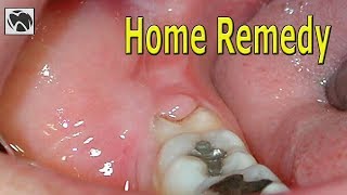 Pericoronitis Home Remedy  Best Pericoronitis Treatment at Home  Wisdom Teeth [upl. by Annala]