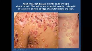 Lecture 49 Bullous Pemphigoid and related diseases PartII Rooks chapter 50 [upl. by Alius]