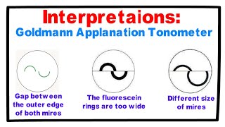 iop measurement  iop measurement with applanation tonometry  tonometry [upl. by Adnirod]