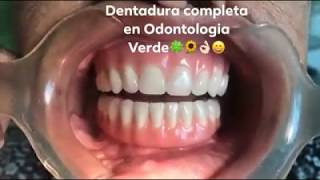 Dentadura Postiza Completa [upl. by Eetse]