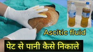 Ascites Fluid tapping Procedure  Dr Subodh SKP [upl. by Sesylu766]