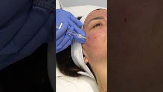 INNO CE® SCARS Application protocol by Dr Anna Tsebrovska scars innoce [upl. by Asyle]