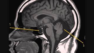 Empty Sella Syndrome and an Arachnoid Cyst 1 0001 [upl. by Moody]