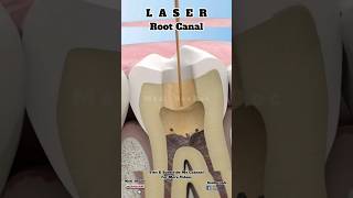 Root Canal Treatment with Laser Explanation about teeth Bacteriadentist teeth rootcanal [upl. by Niac]