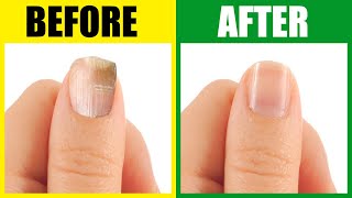 Find Out The Deeper Causes of Brittle Nails [upl. by Edi]