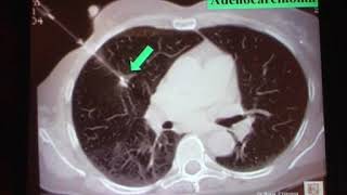 15 Neoplasie del Polmone Le biopsie polmonari Giancarlo Bosio [upl. by Aamsa]