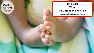 What is clubfoot and how is it treated An overview [upl. by Wallas]