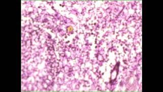 Loose c t  reticular Lymphnode reticulin stain [upl. by Dilaw]