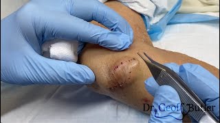 Removal of a fairly large epidermal cyst on the elbow [upl. by Killian]