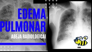 Edema pulmonar [upl. by Yerd247]