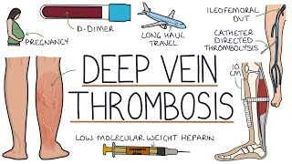 Understanding Deep Vein Thrombosis DVT [upl. by Rodgers]