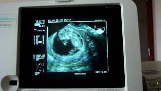 A Fetal Ultrasound at 12 Weeks [upl. by Eidarb]