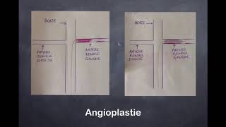 Sténose de lartère rénale  2 Radiologie Interventionnelle [upl. by Ainatnas110]