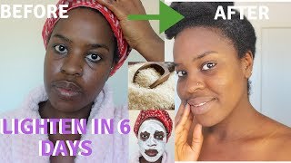 How I How i BRIGHTENED MY SKIN IN 6 DAYS REALISTIC and Natural way to reduce hyperpigmentation [upl. by Lienahs]