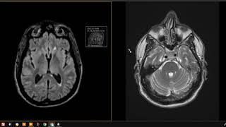 54 year old with left ear infections [upl. by Lidstone]