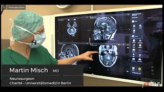 Brain Biopsy of a Suspected Cerebellar Lymphoma by Martin Misch Dr med Links to Full Procedure [upl. by Nessie352]