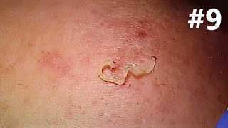 BLACKHEADS EXTRACTIONS on Happy   9 [upl. by Chura735]