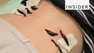 Holistic Center Performs Leech Therapy [upl. by Comptom36]