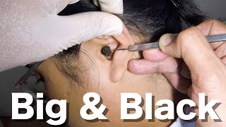 Big Black Earwax STUCK in Young Womans Ear Removed [upl. by Viridi431]