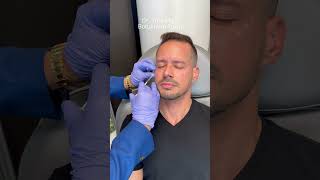 Botox for Men botulinumtoxin [upl. by Aicilihp]