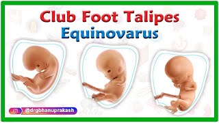 Club foot  Talipes equinovarus  Causes Symptoms Diagnosis and Treatment [upl. by Georgena]