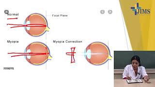 Topic  Errors of Refraction [upl. by Xonel]