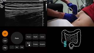 Ultrasound Tutorial AppendixAppendicitis  Radiology Nation [upl. by Ahsilahs]