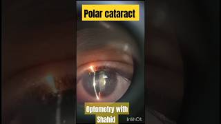 Polar cataract  polarcataract cataract eyediseases [upl. by Ramsden]