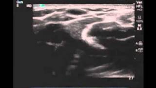 How To Peripheral Arm Veins for Vascular Access Scanning Technique Video [upl. by Evangeline538]